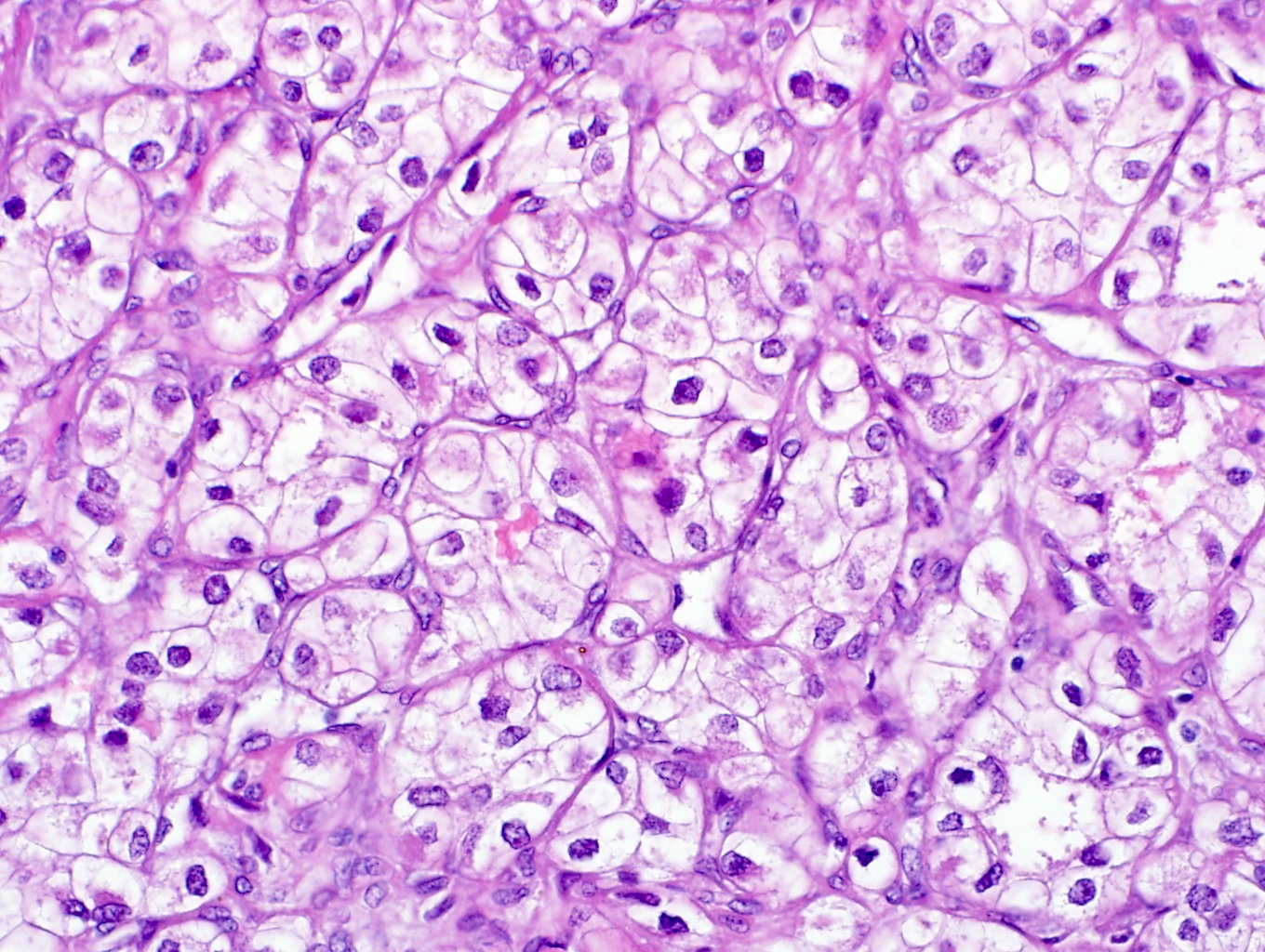 Metastatic clear cell renal cell carcinoma