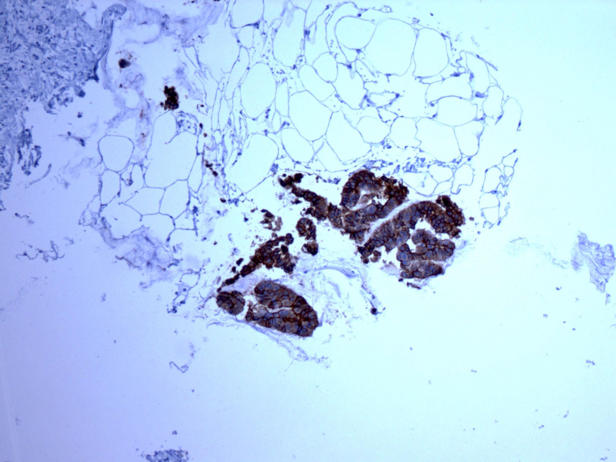 HER2+ mucinous micropapillary carcinoma