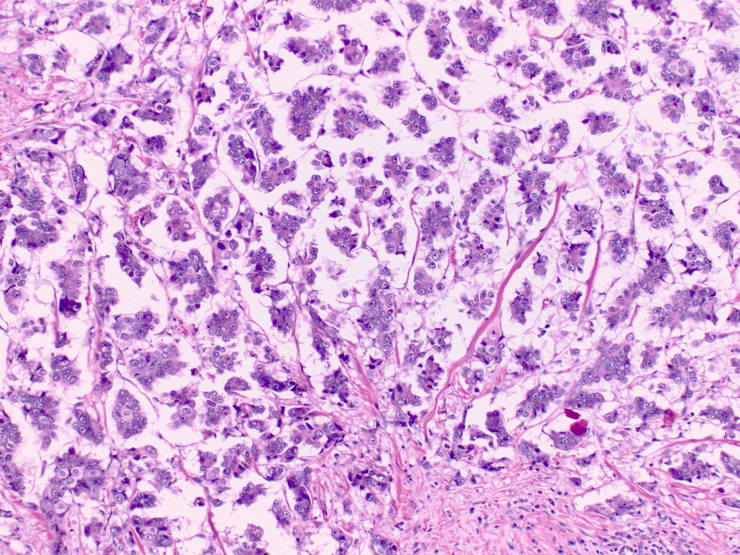 Micropapillary carcinoma