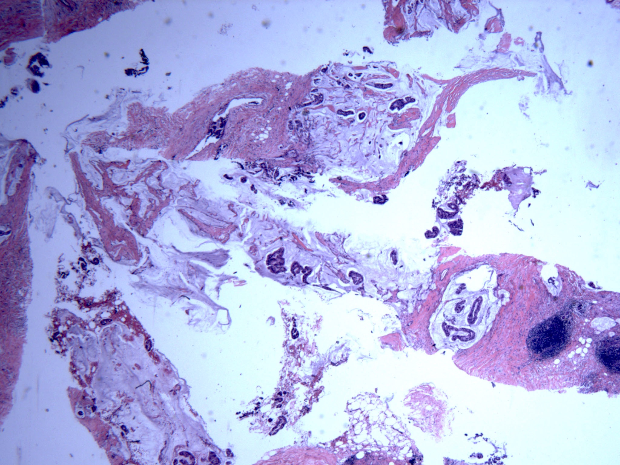 Mucinous micropapillary carcinoma