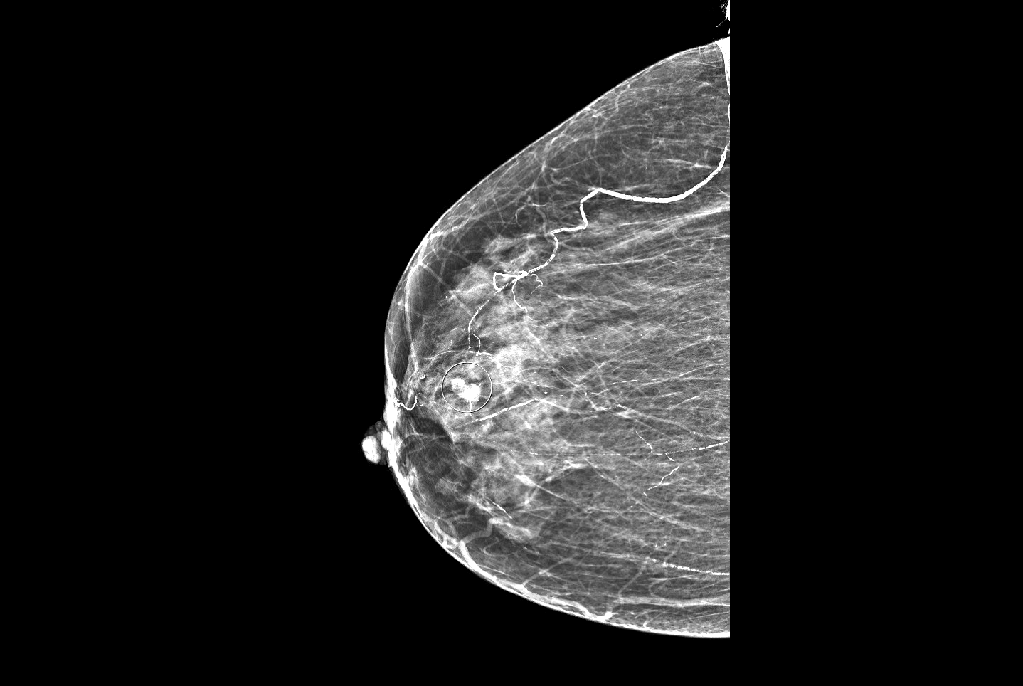 Mammogram of right breast