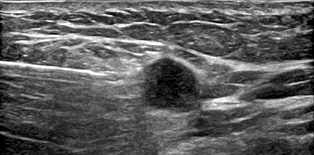 Ultrasound of left breast