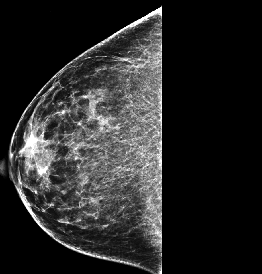 Mammogram of breast mass