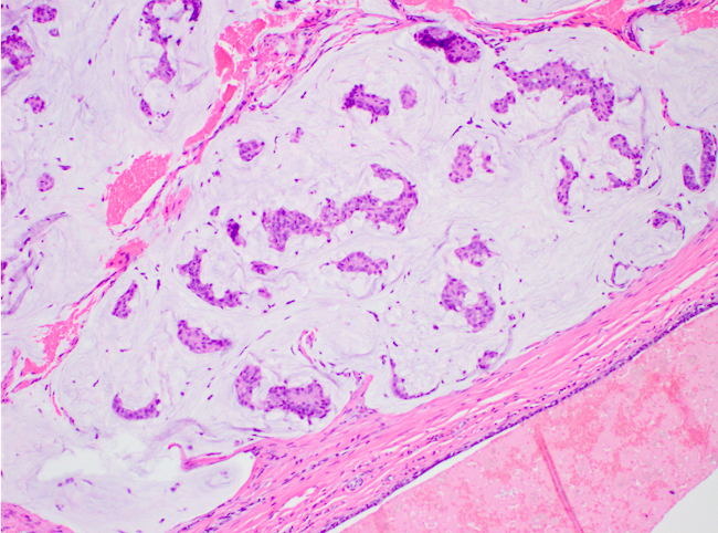 Type A mucinous carcinoma