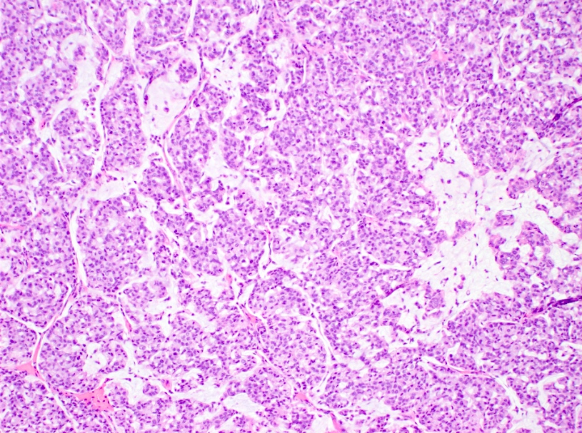 Type B mucinous carcinoma