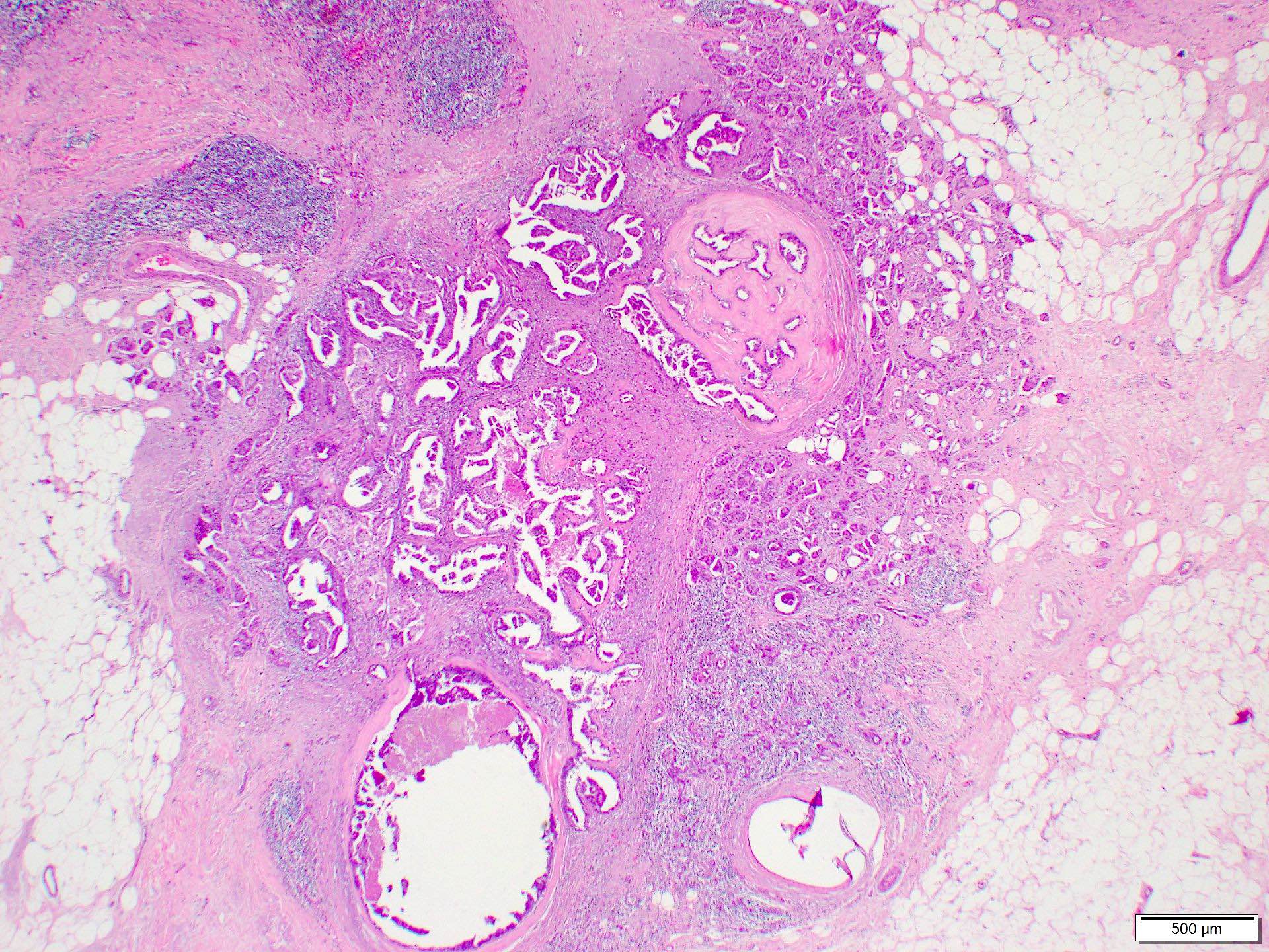 Invasive mixed papillary and micropapillary carcinoma