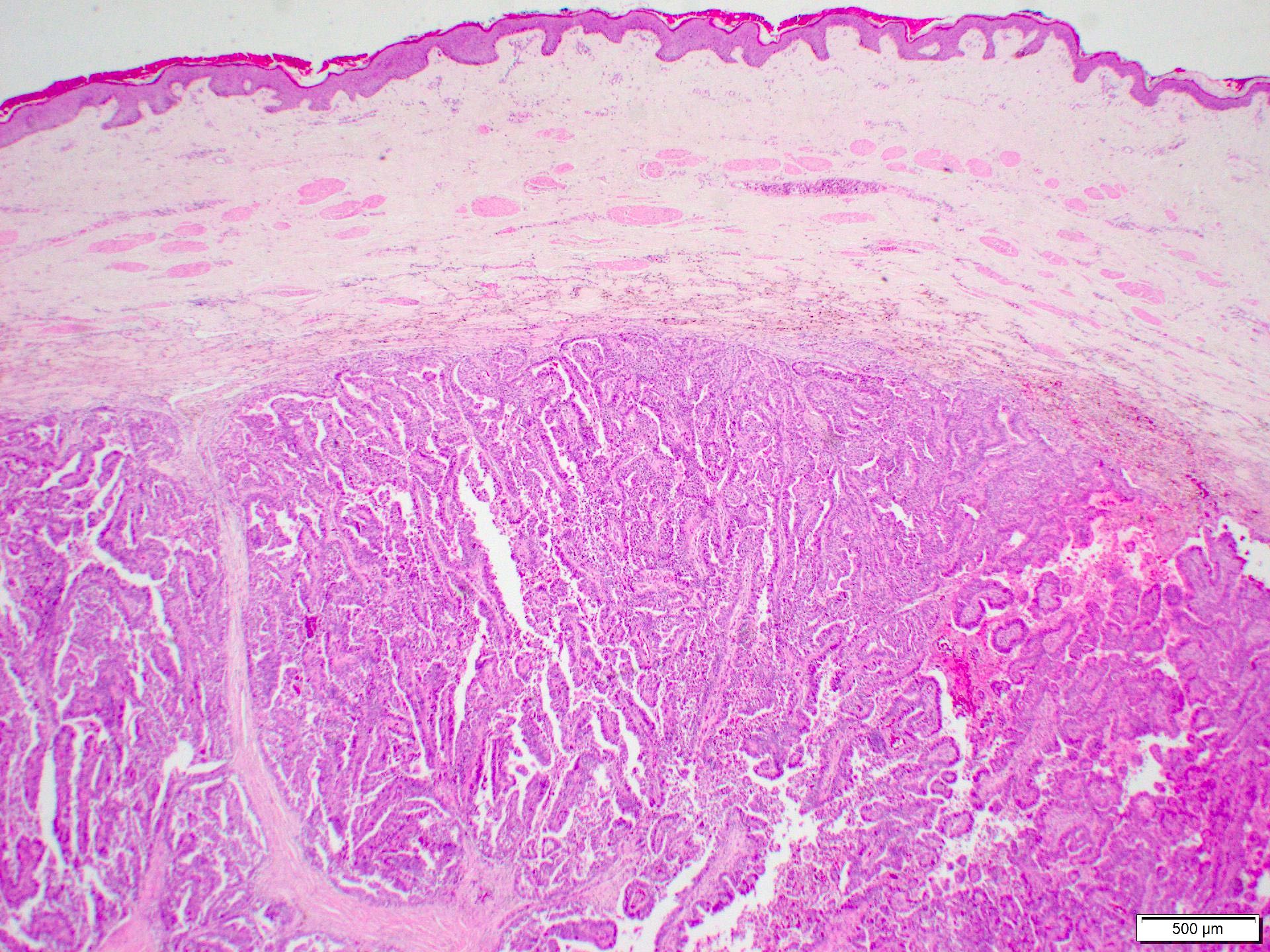 Invasive papillary carcinoma