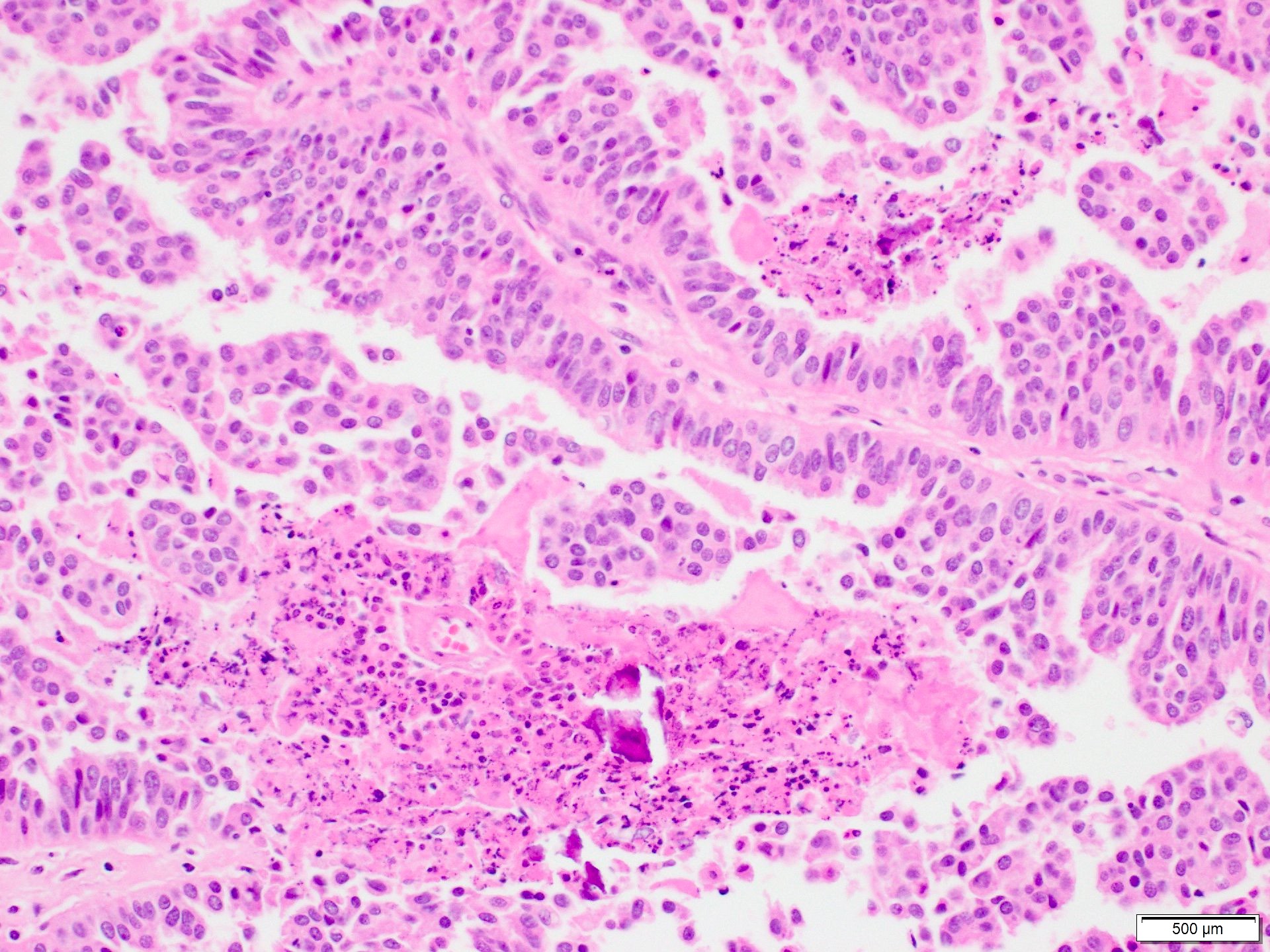 intraductal papilloma with dcis pathology outlines)