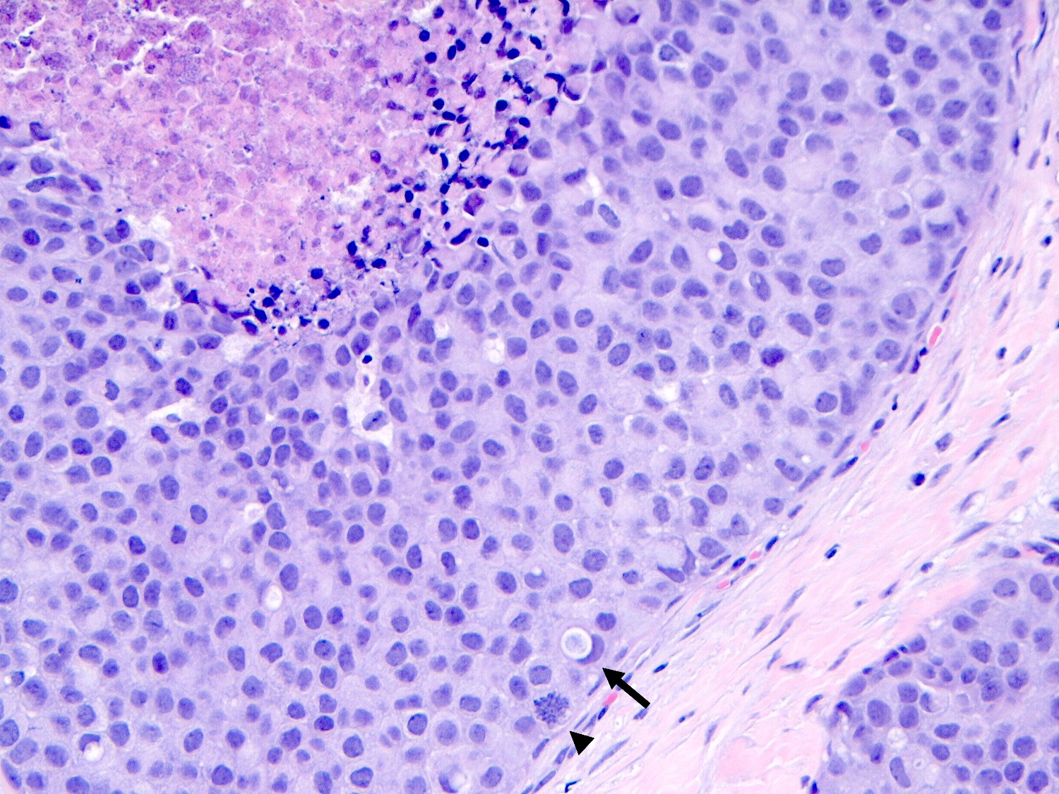 PLCIS with central necrosis and calcifications