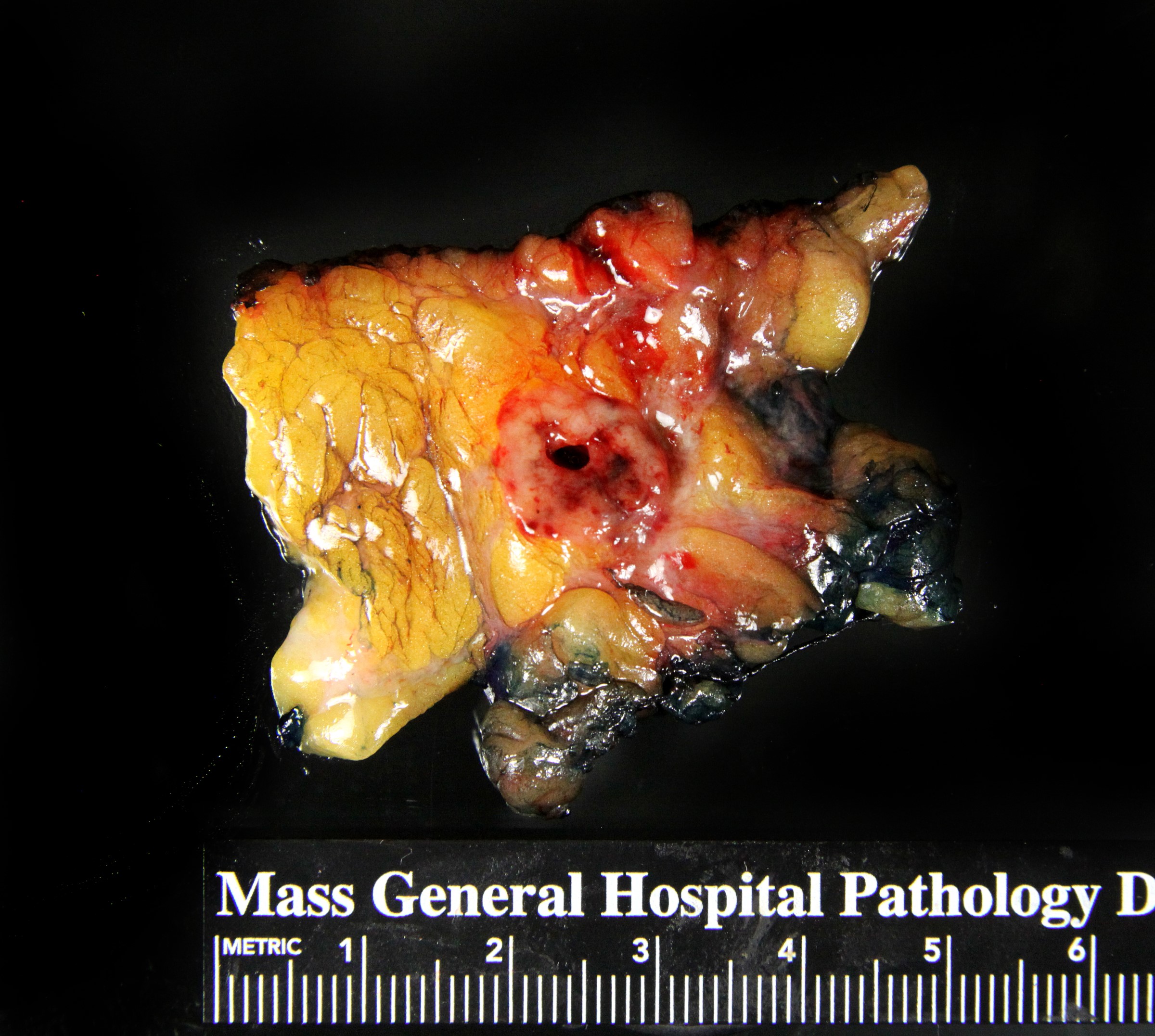 Invasive solid papillary carcinoma