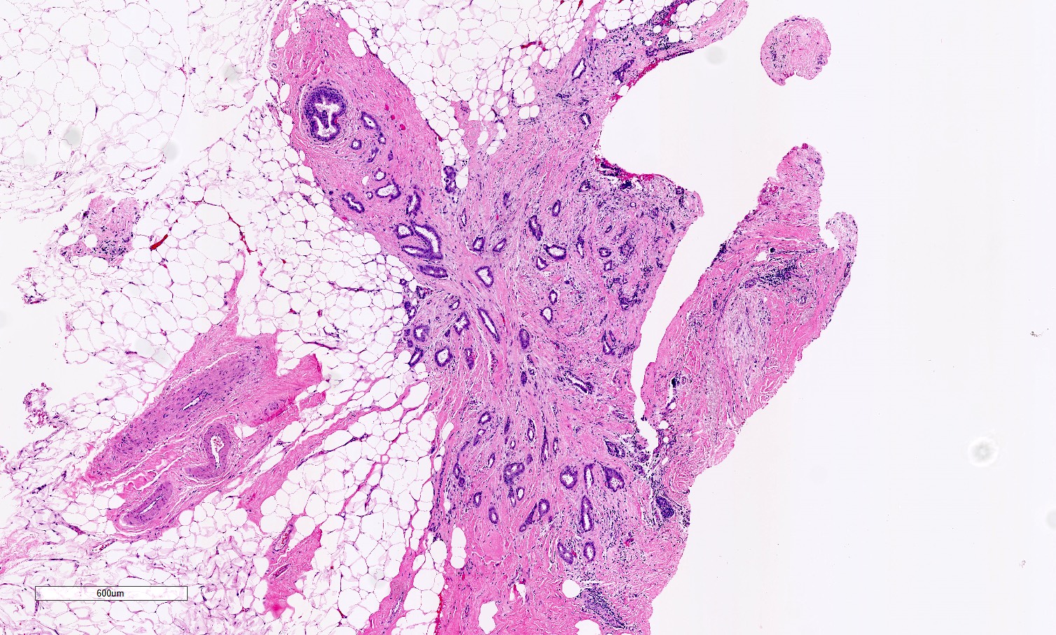 Tubular carcinoma