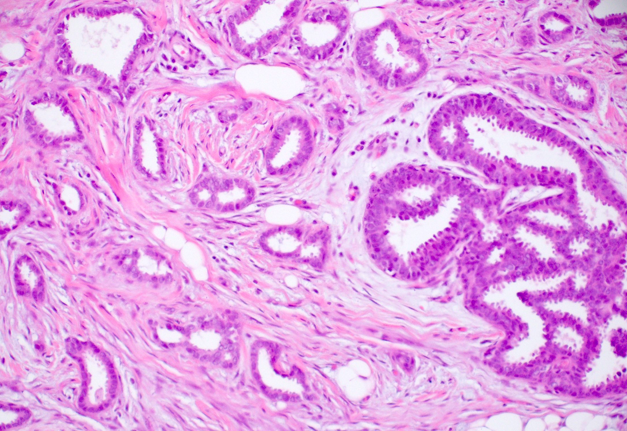 Associated atypical ductal hyperplasia / flat epithelial atypia