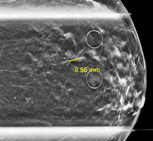 Diagnostic mammogram