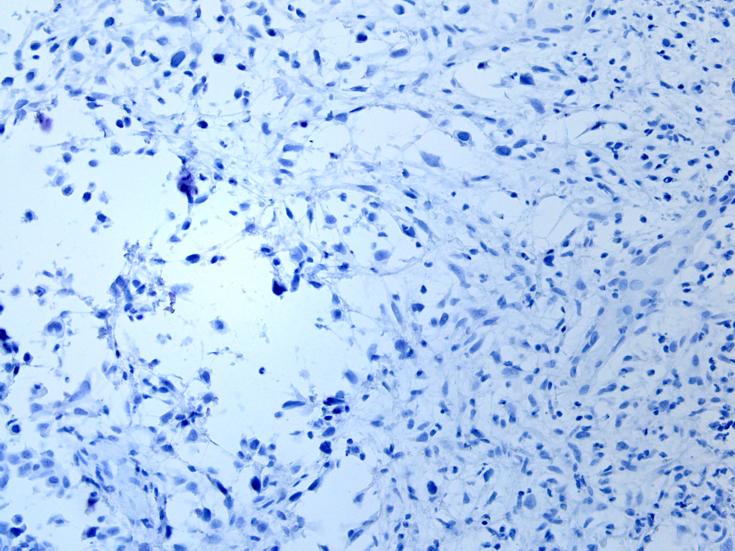 Spindle cell carcinoma
