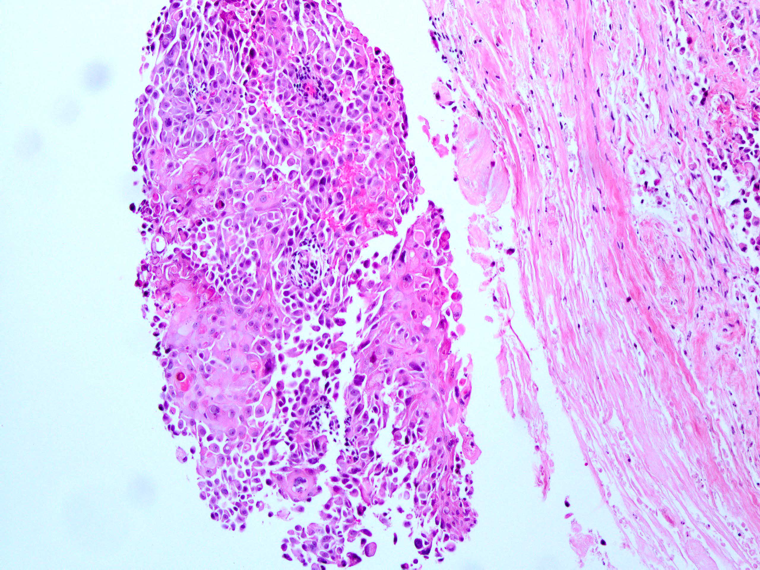 Metaplastic carcinoma with squamous differentiation