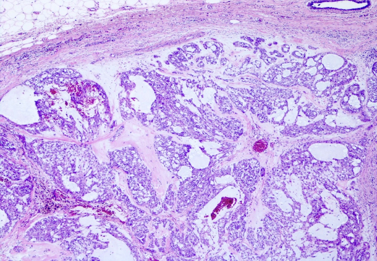 Pleomorf adenoma pathology