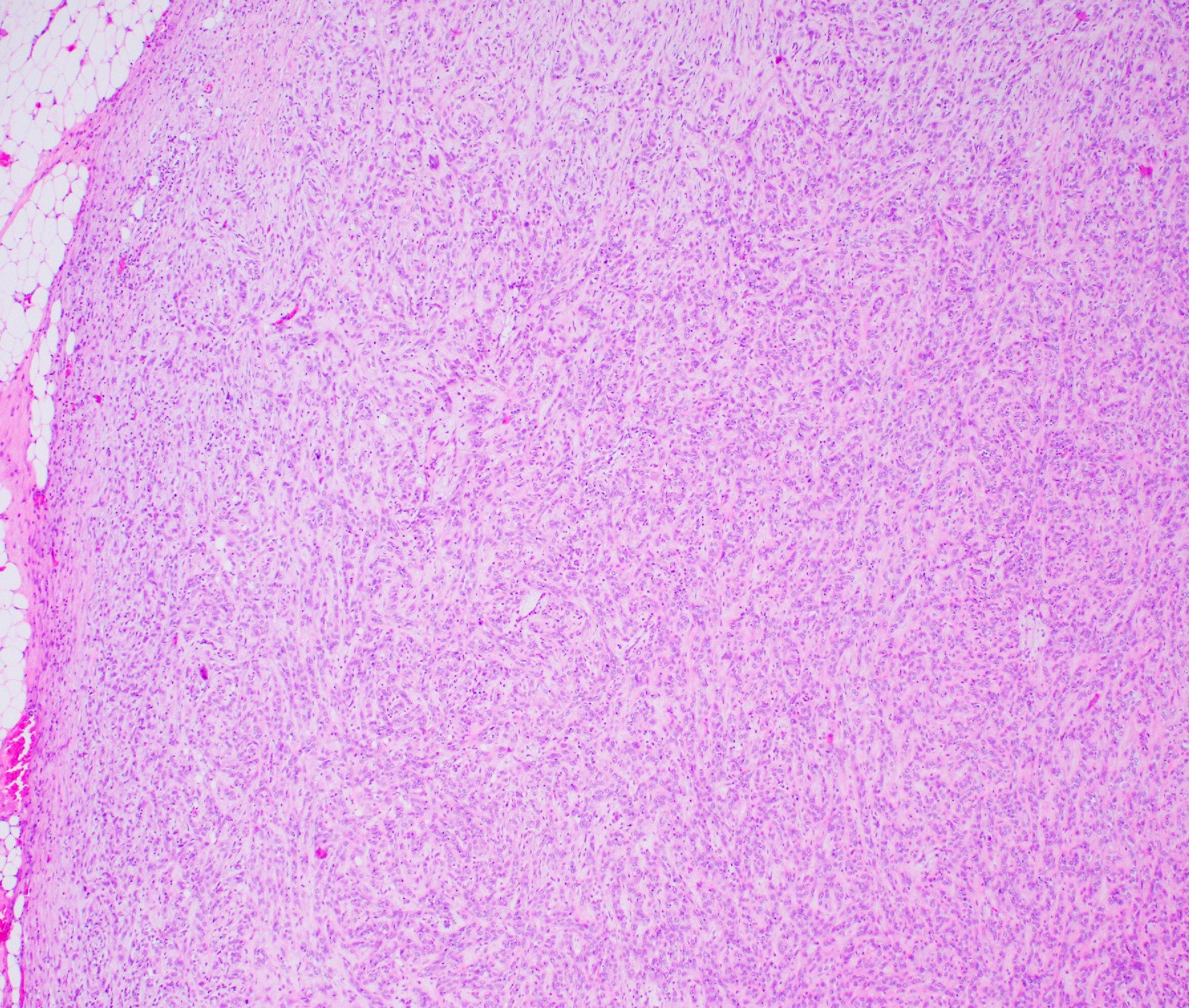 Myoepithelial carcinoma