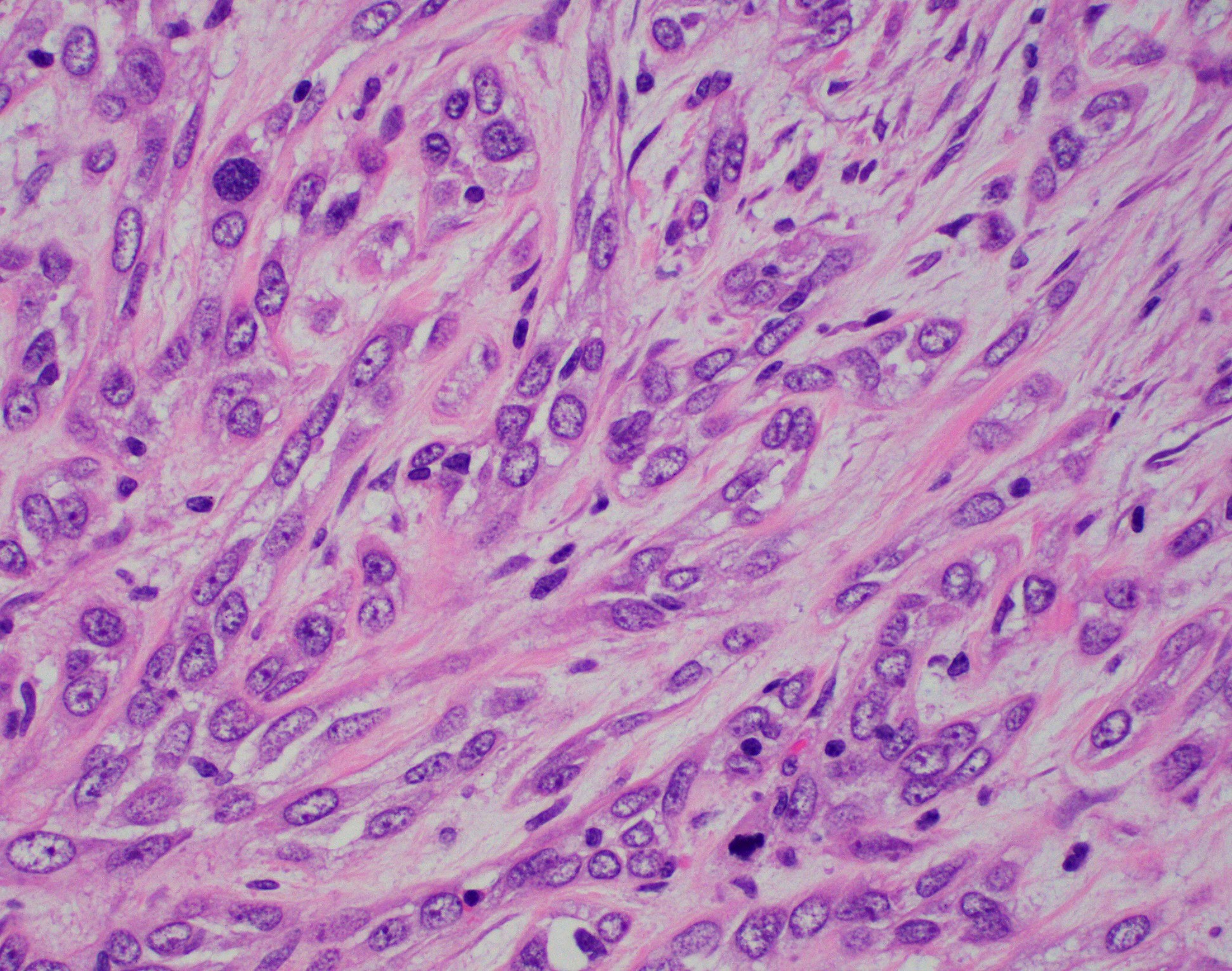 Myoepithelial carcinoma