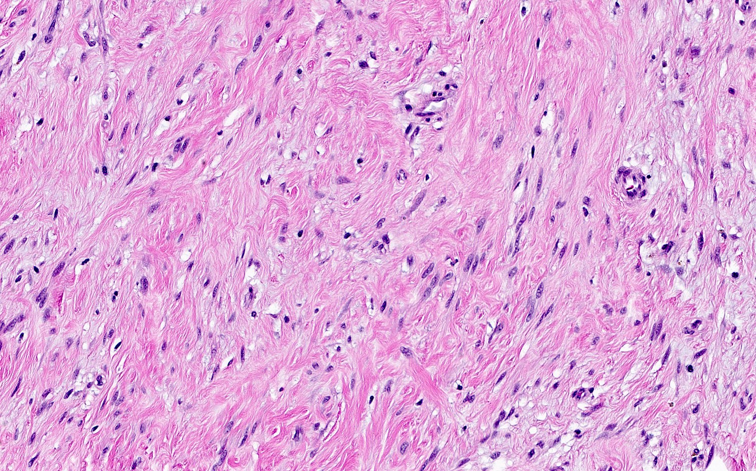 Hypocellular, collagenized / fibrous variant
