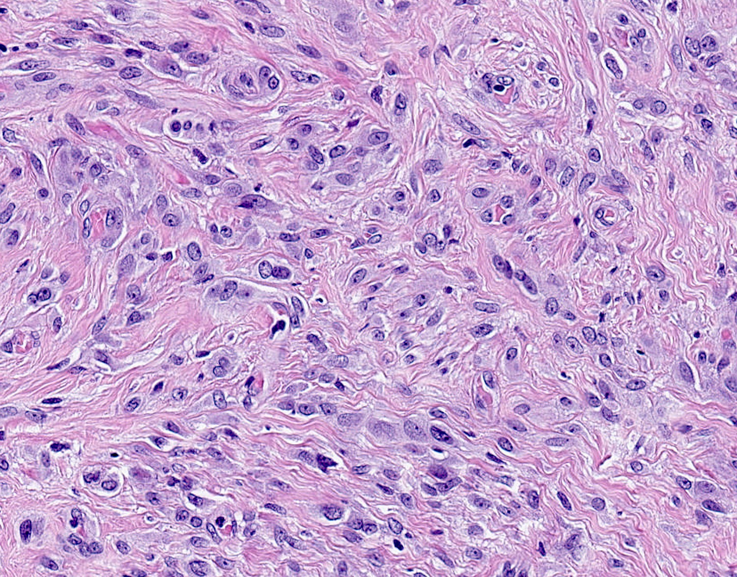 Epithelioid with single file growth