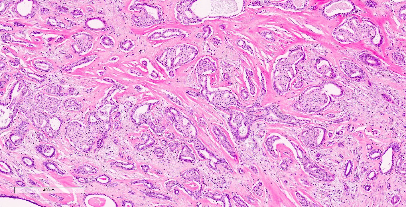 Ductal carcinoma in situ