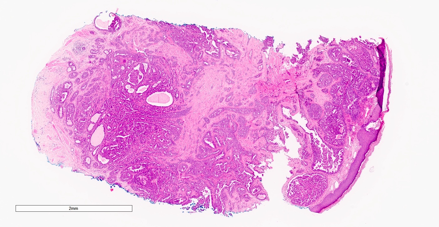 Prominent epithelial proliferation with papillary architecture and tufting
