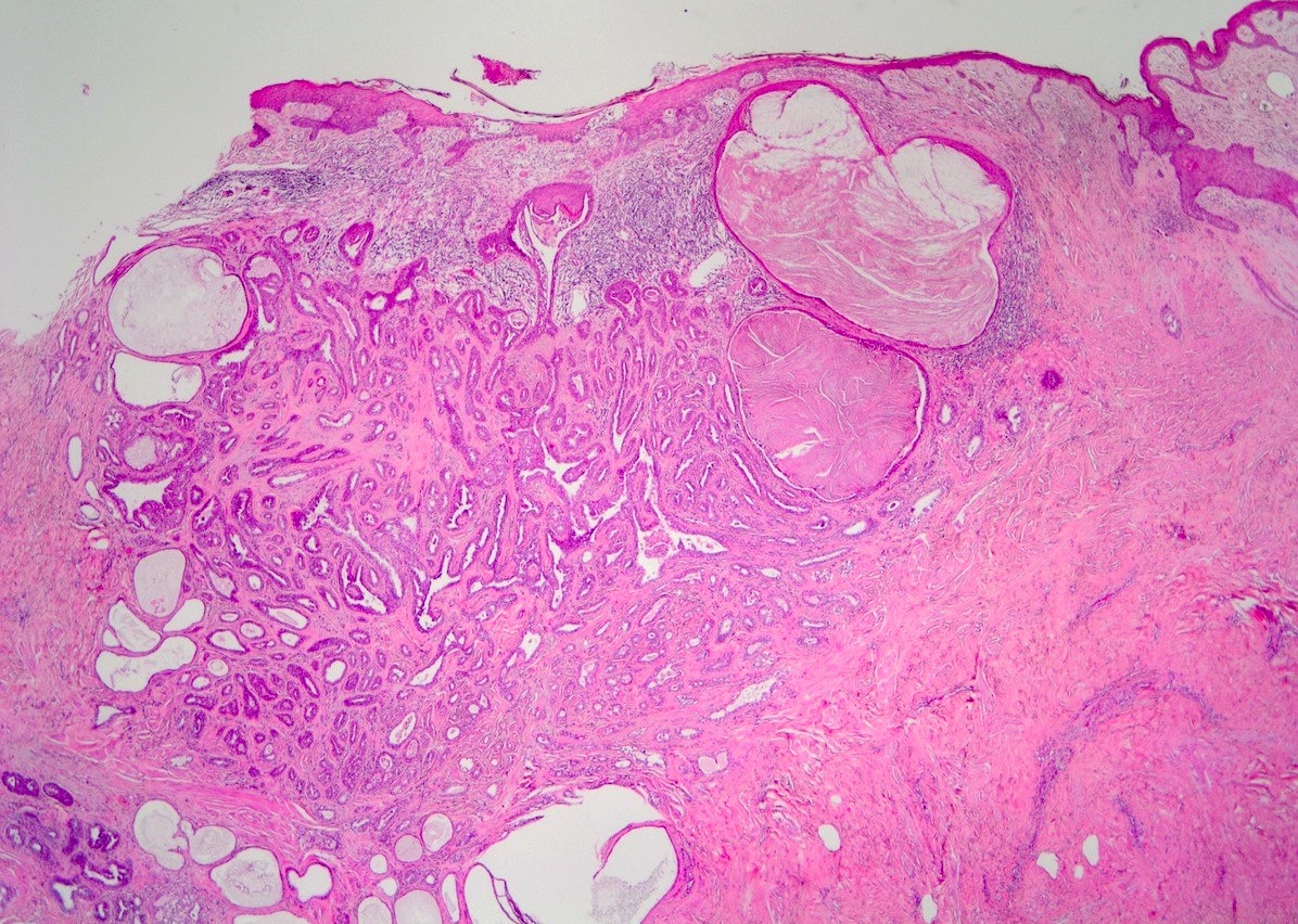 florid papillomatosis of the nipple pathology outlines opriți parazitul