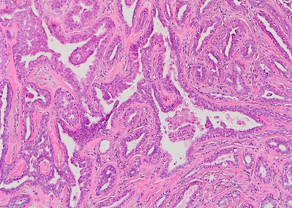 Papillary growth within ducts