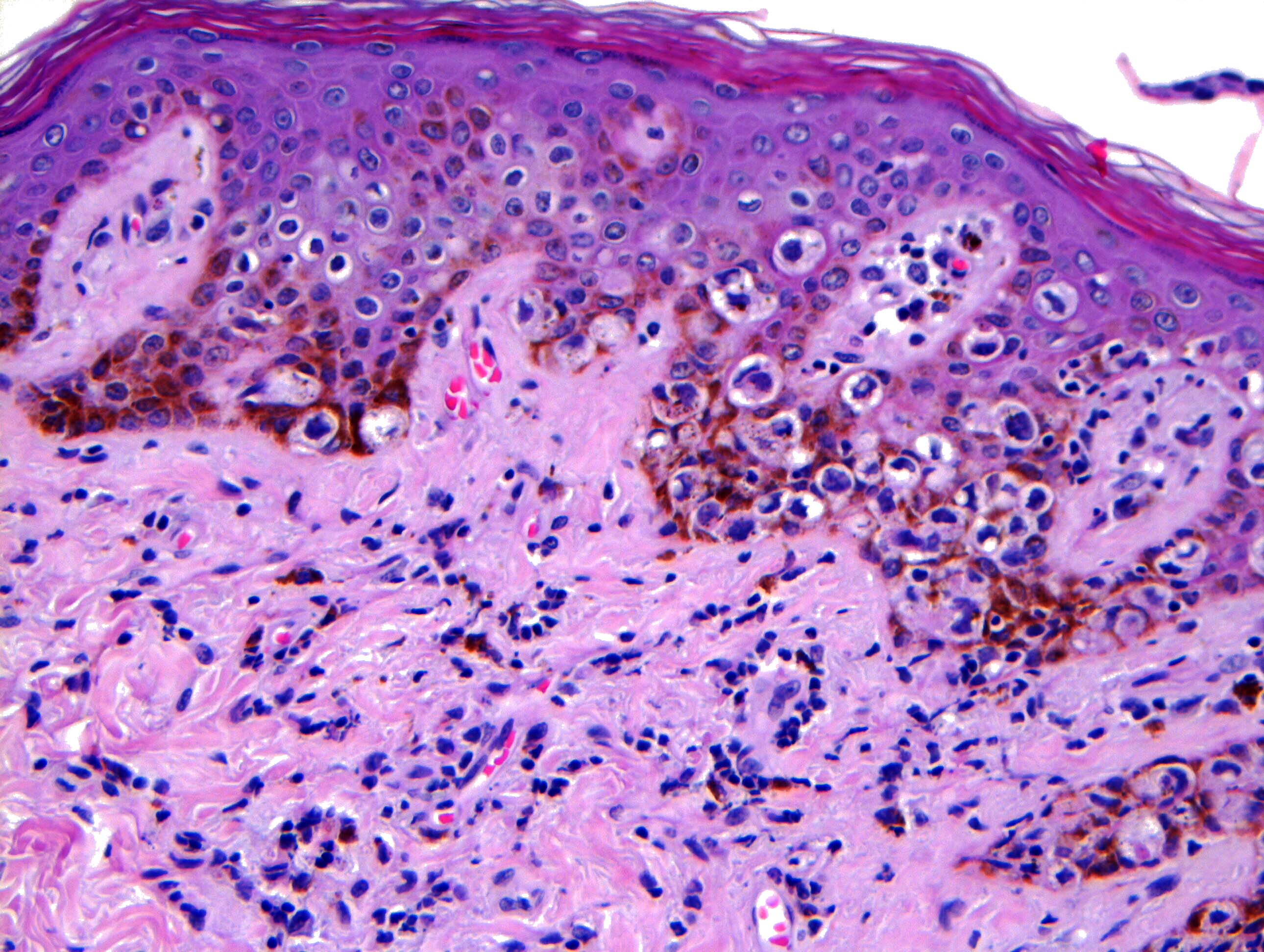 Melanocyte hyperplasia