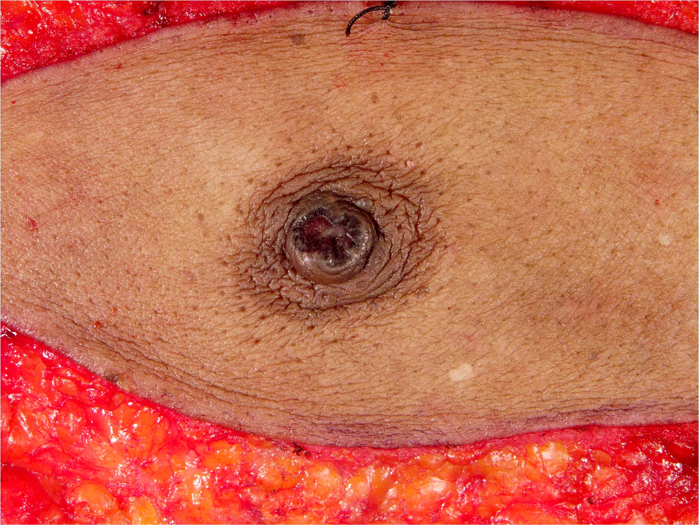Nipple ulceration