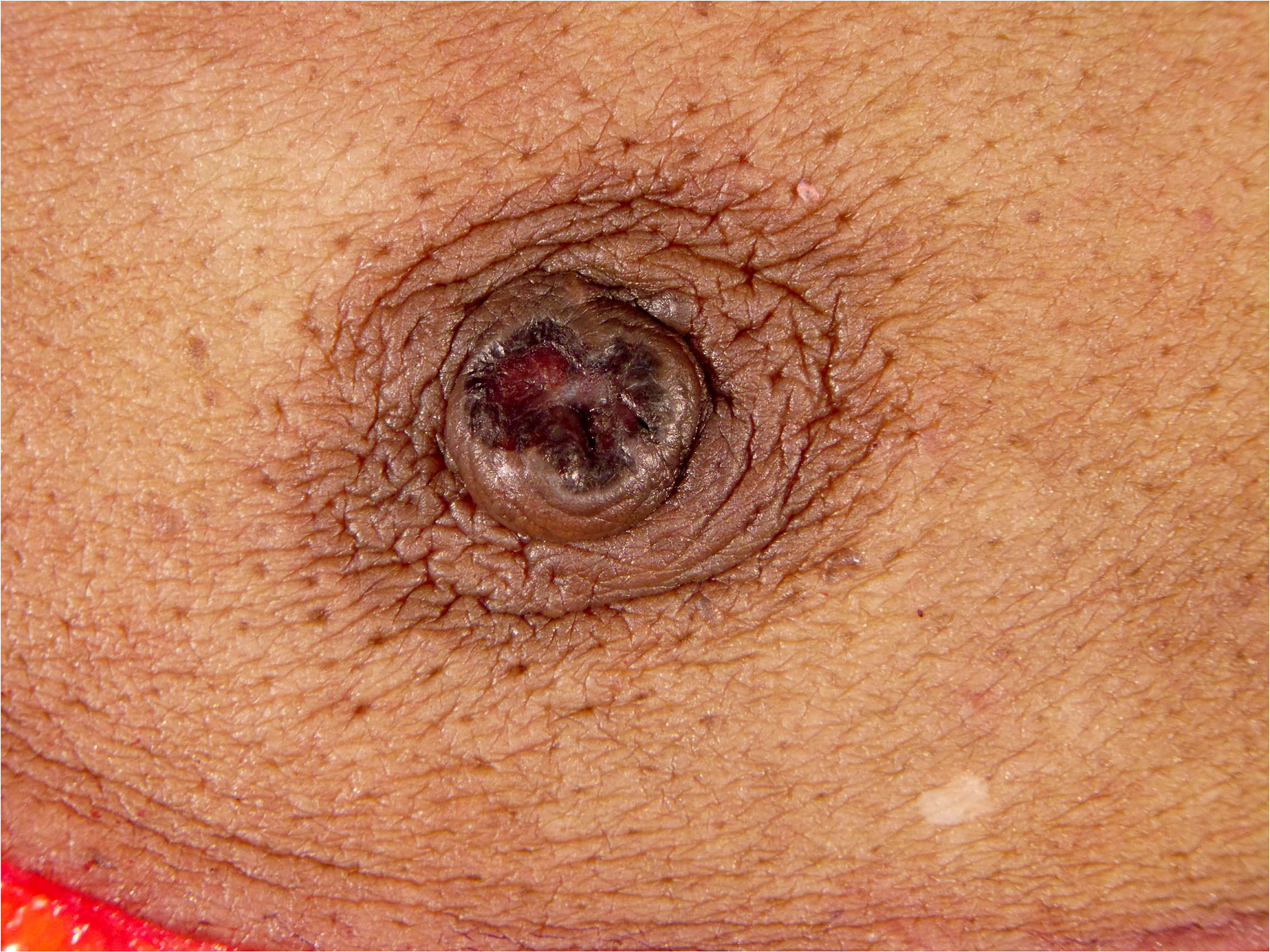 Nipple ulceration, enlarged
