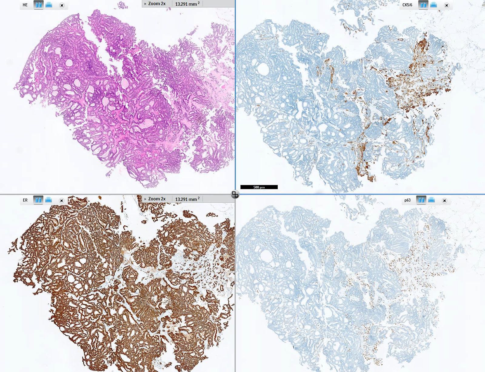 A csont- és ízületi porc jóindulatú daganata (D16) - Sérülések October, Atipikus papilloma icd 10