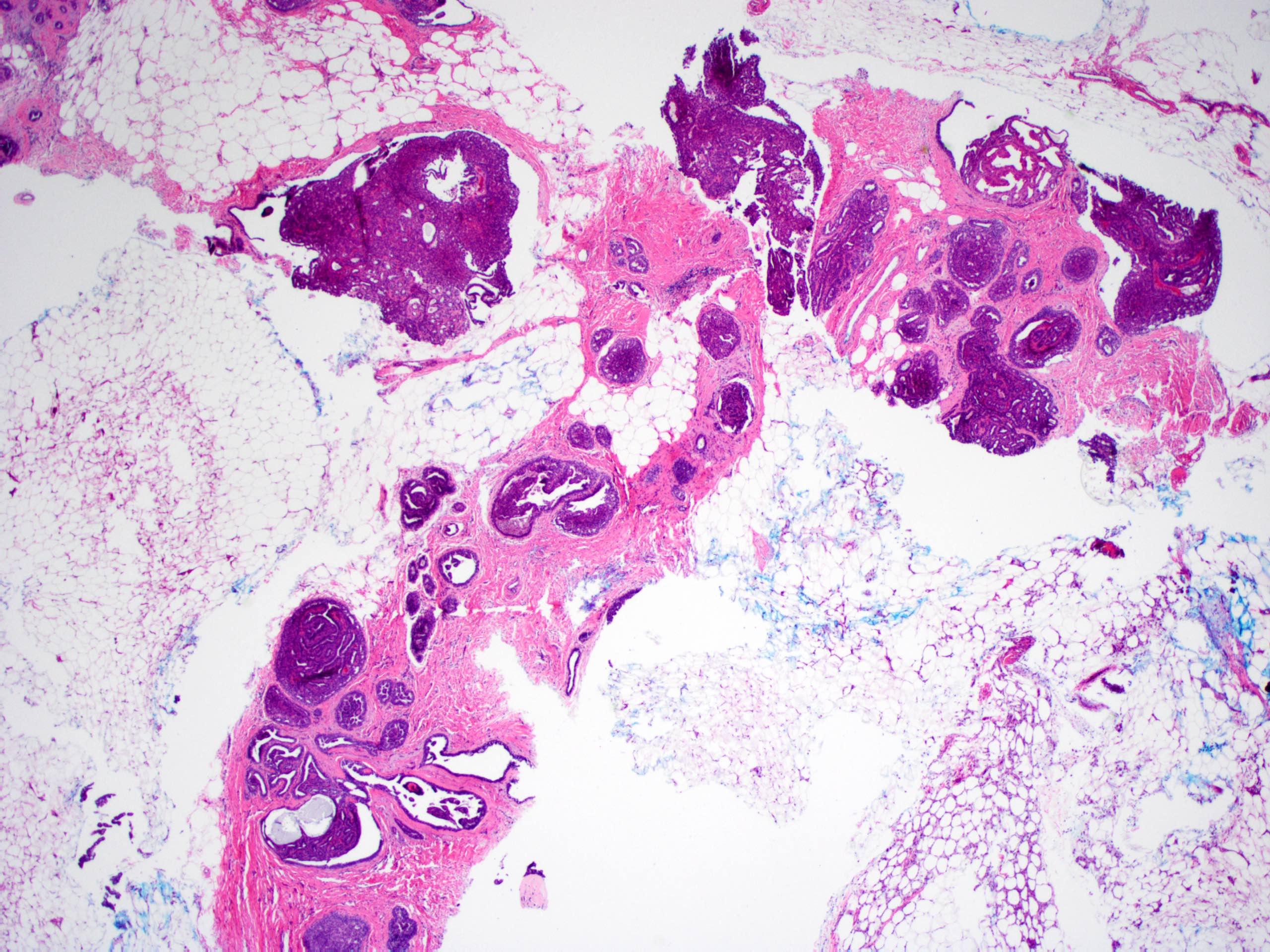 Ductal papilloma histology