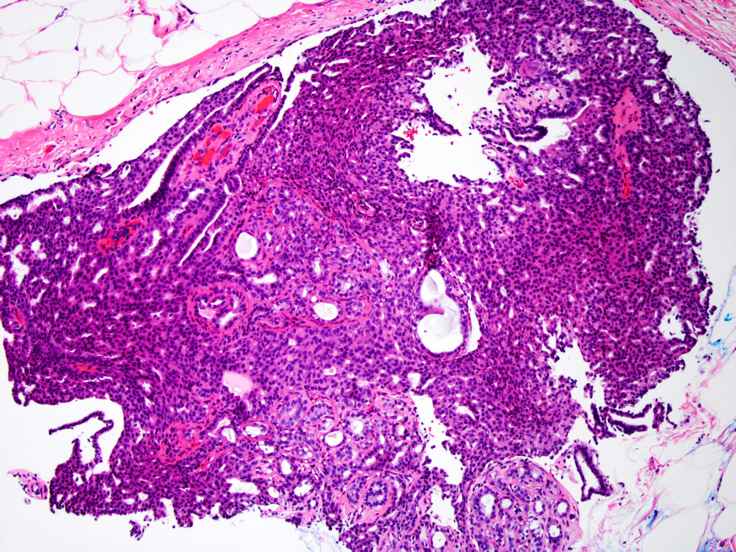 Papillary lesion histology, digitaţie epitelia-lă, epiteliul epithelial peg