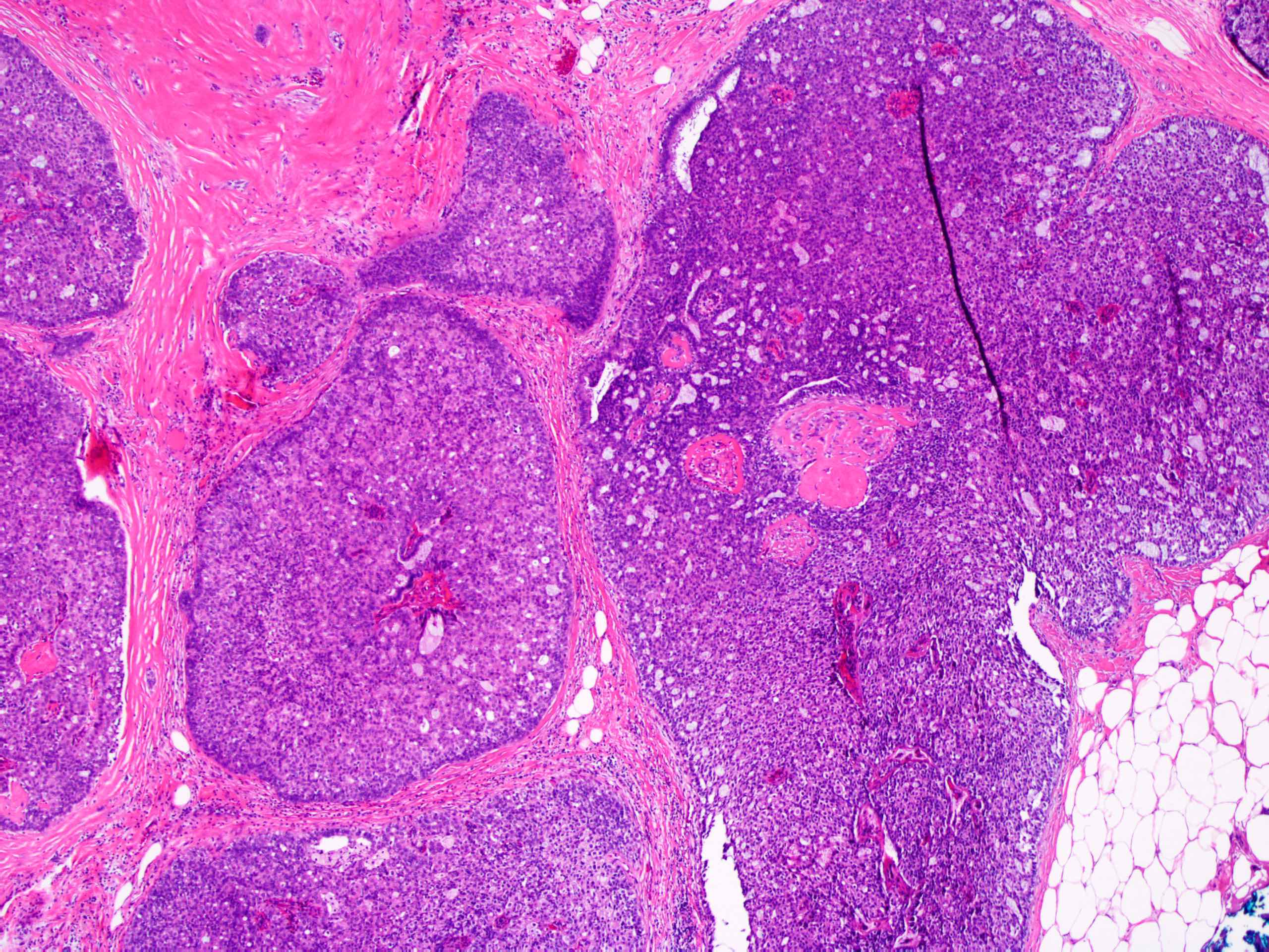 ductalis papillomatosis hyperplasia