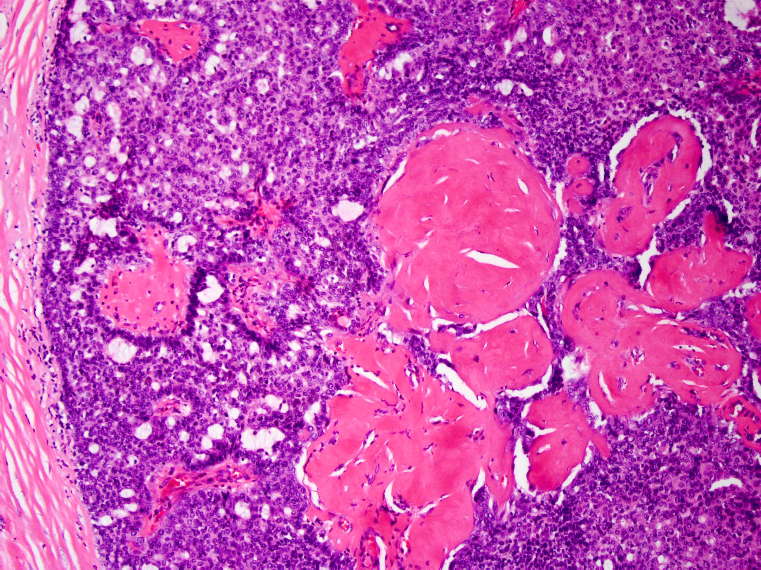Intraductal papilloma with florid usual ductal hyperplasia - Epidermal hyperplasia definition