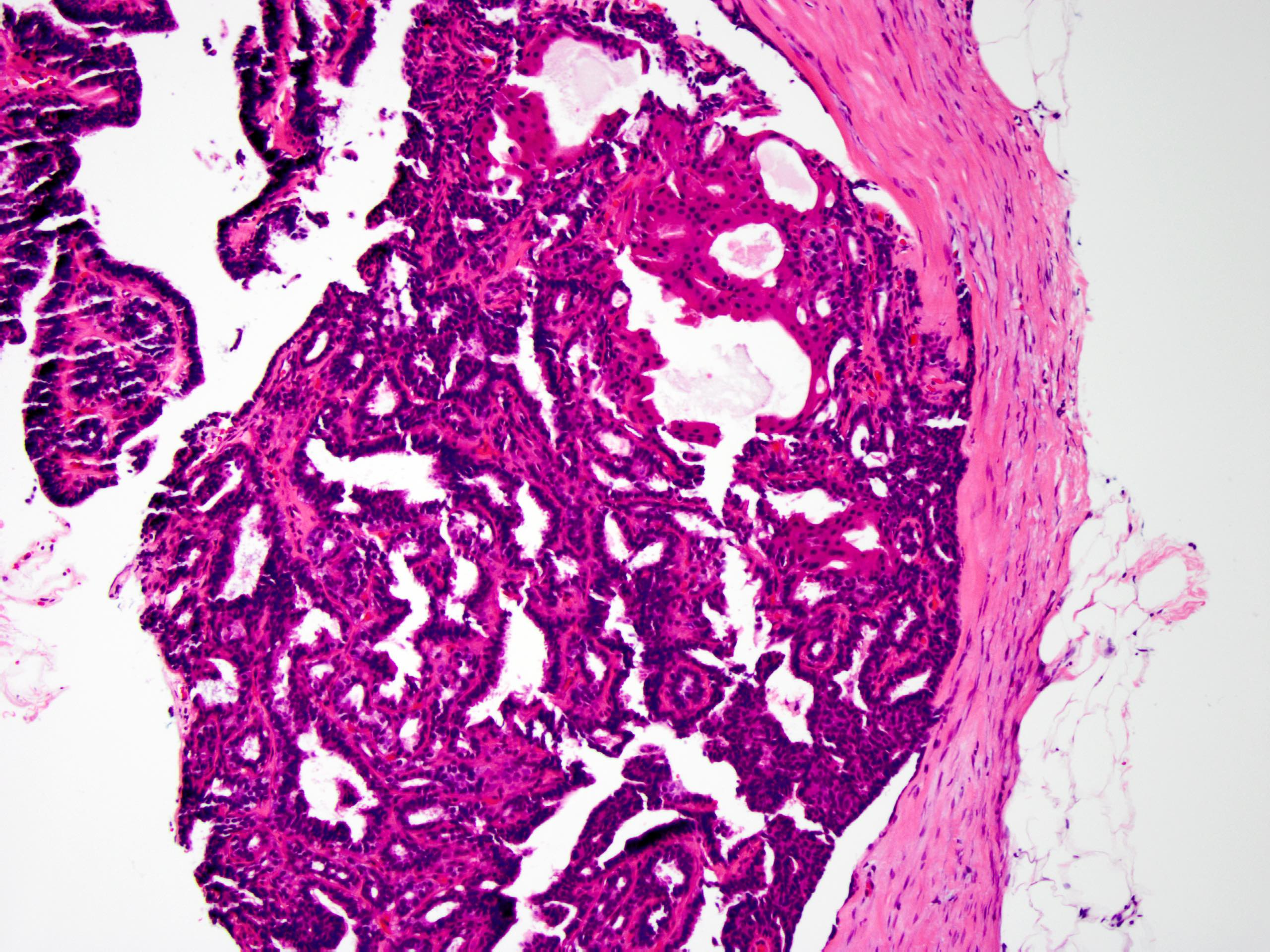 Mell intraductalis papilloma atypiával