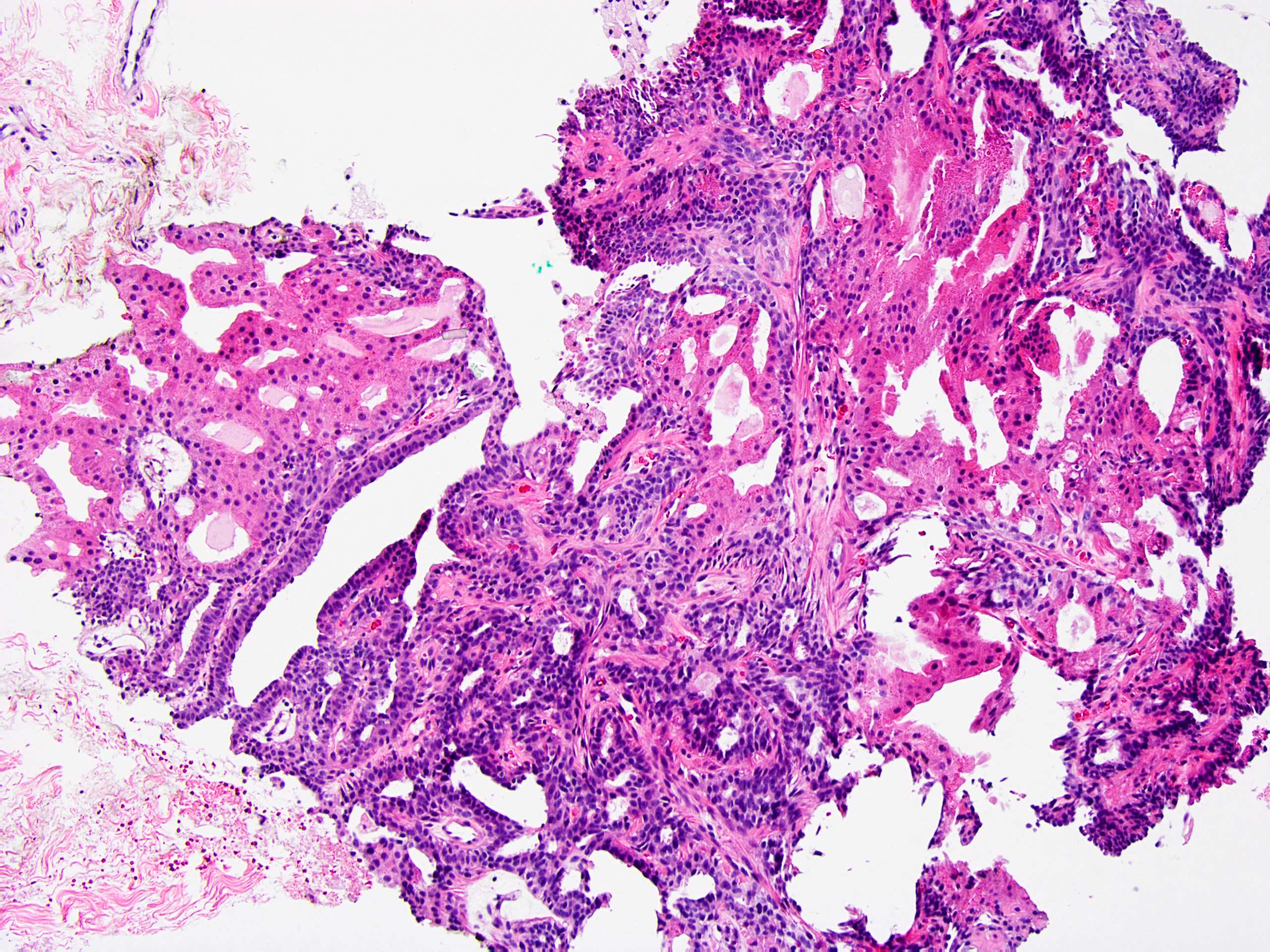 intraductal papilloma pathology outline)