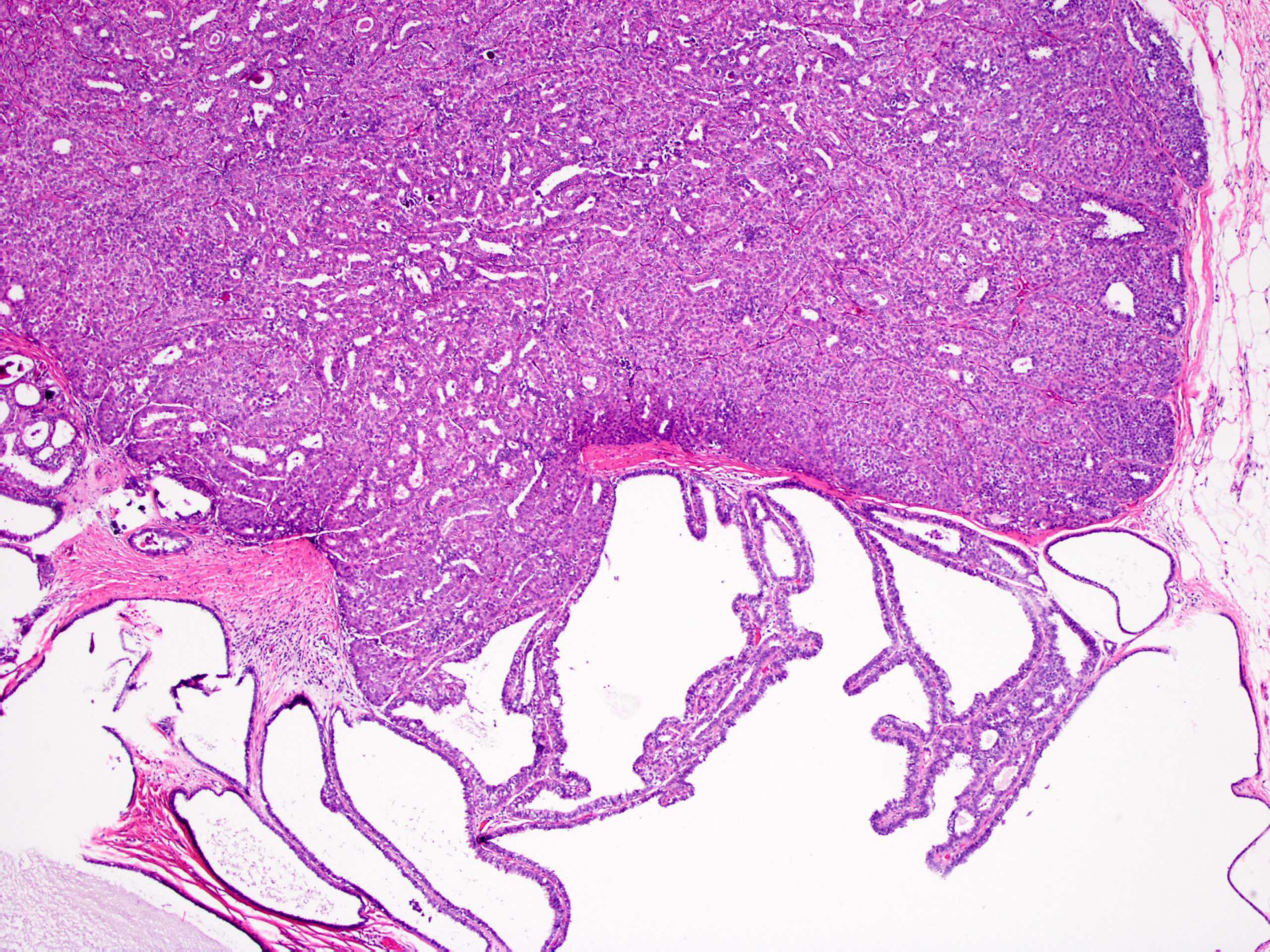 intraductalis papilloma kiterjedt apokrin metapláziával