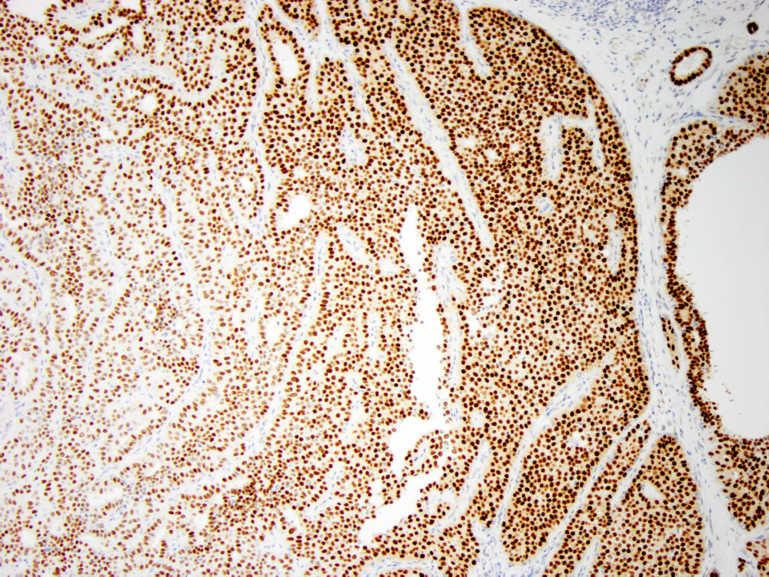 hólyag papilloma 1 cm papilloma lágyrész tömege