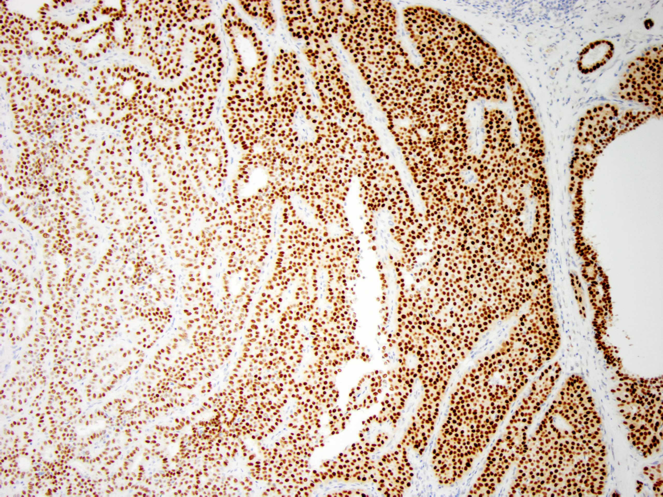 Intraductalis papilloma ihc - vasfehu