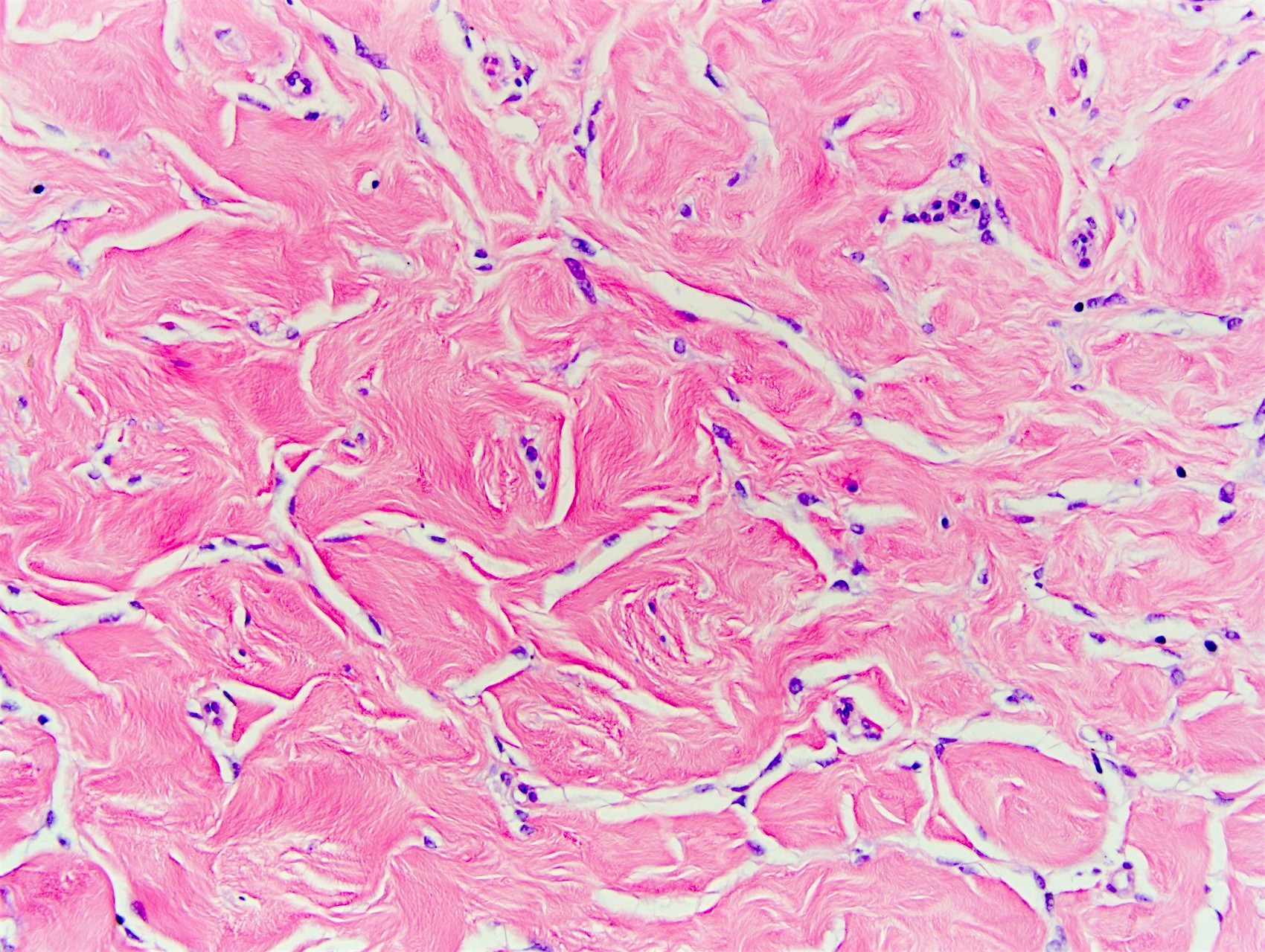 Pathology Outlines Pseudoangiomatous Stromal Hyperplasia.