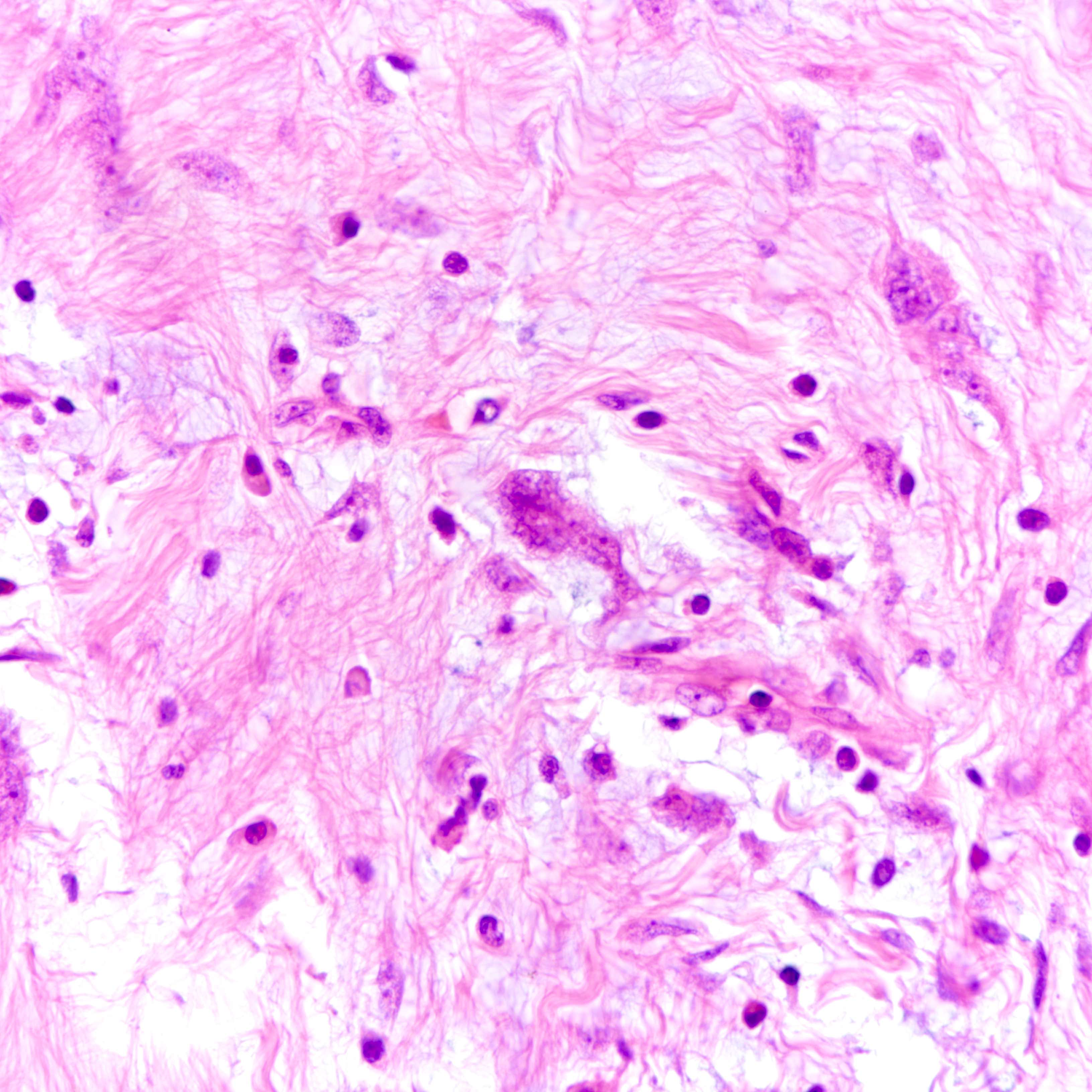 Stromal giant cells