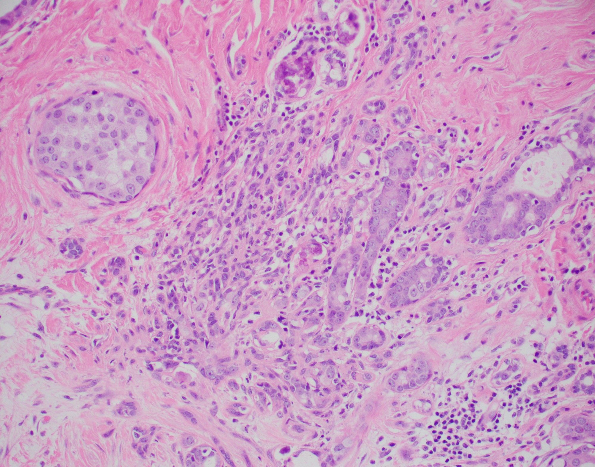 Sclerosing adenosis with DCIS