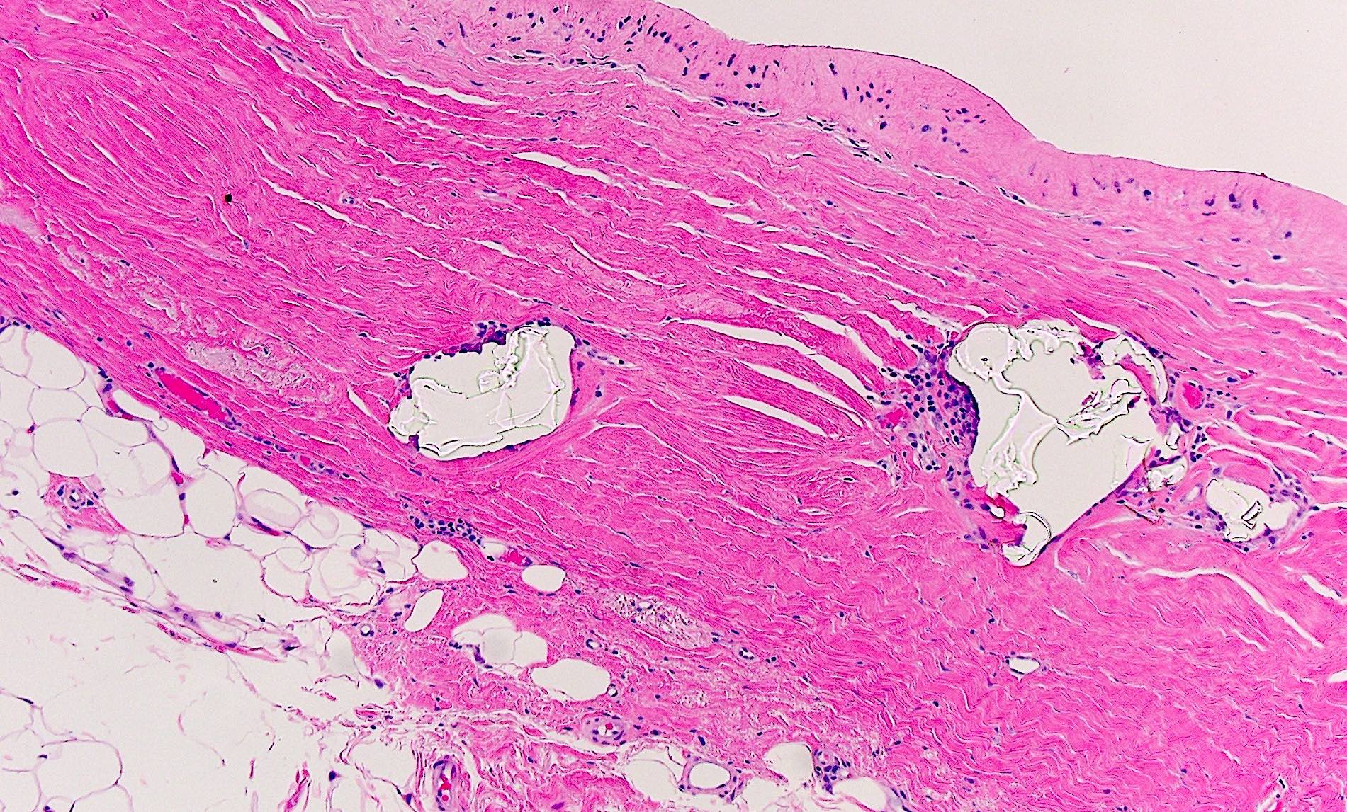 Silicone and synovial metaplasia