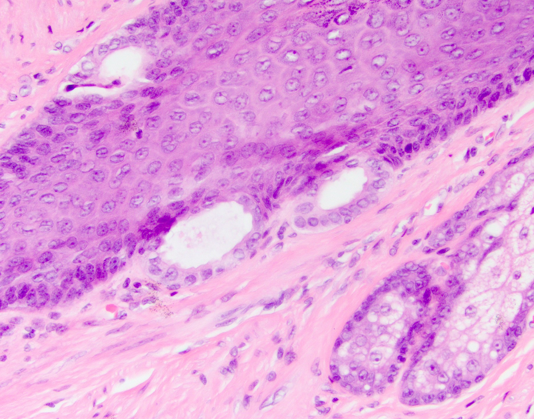 Toker cell hyperplasia
