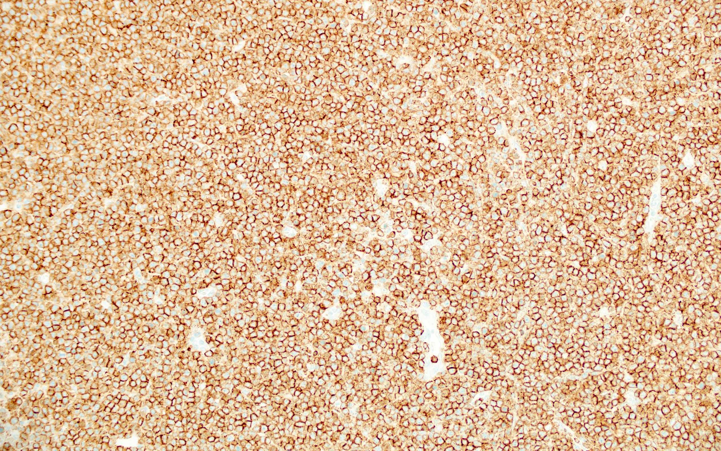 Burkitt lymphoma cells, CD20+