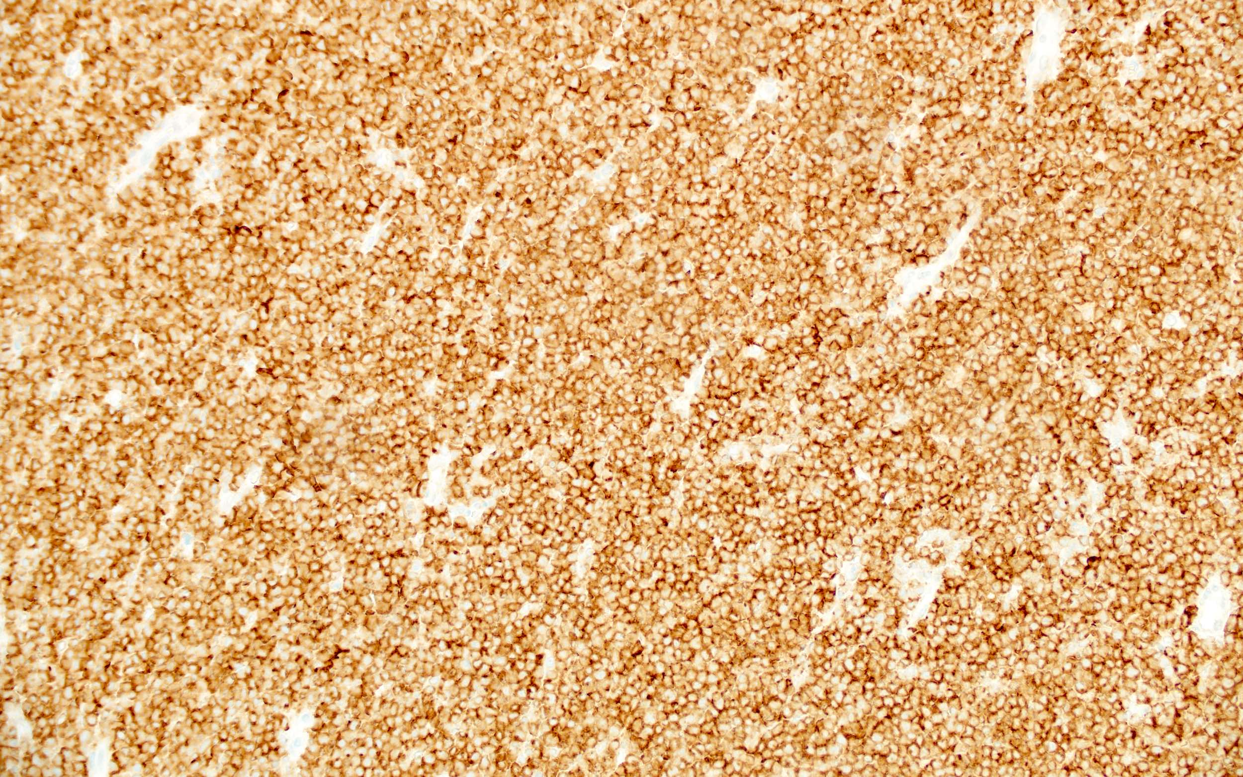 Burkitt lymphoma cells, CD10+