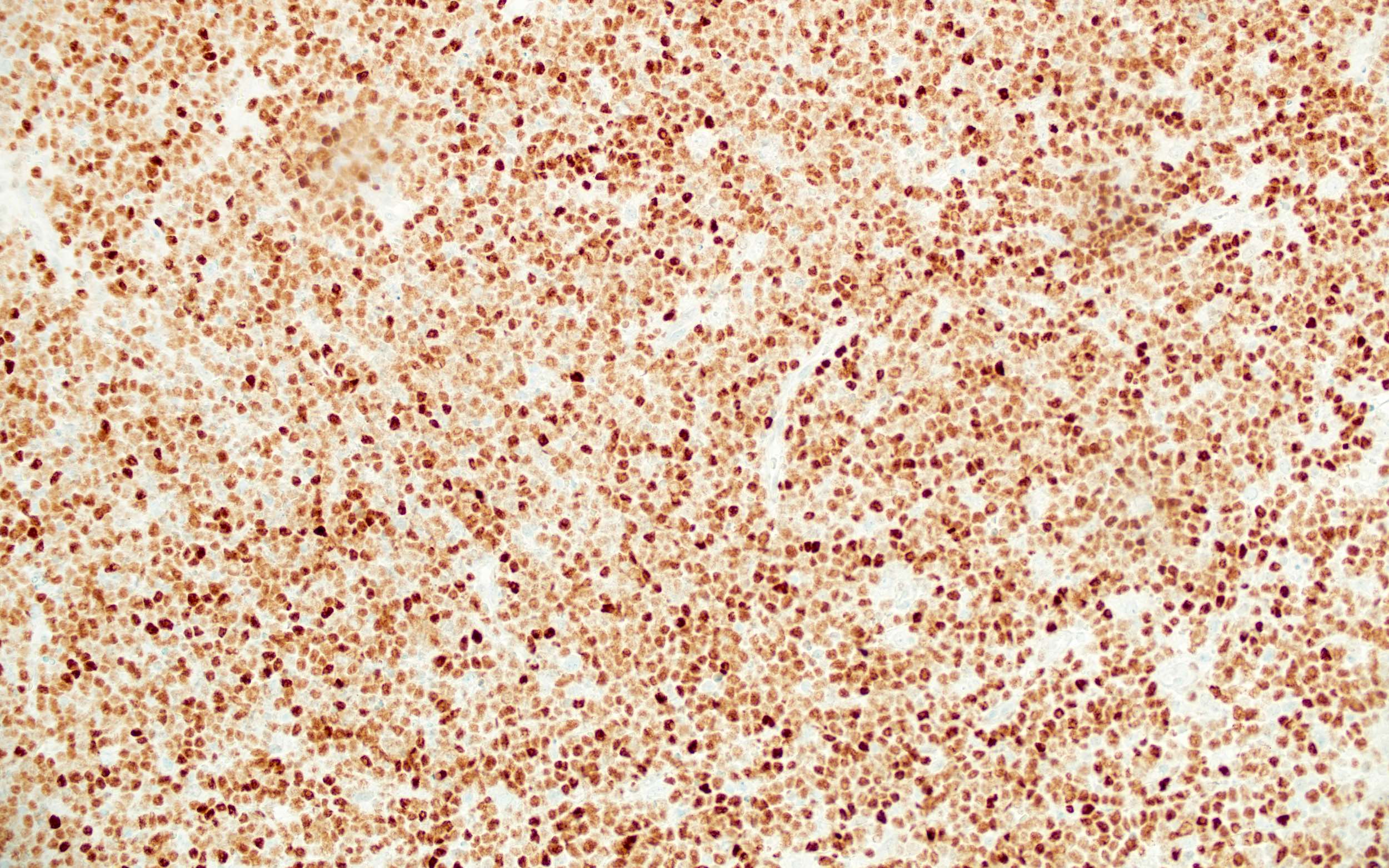 Burkitt lymphoma cells, BCL6+