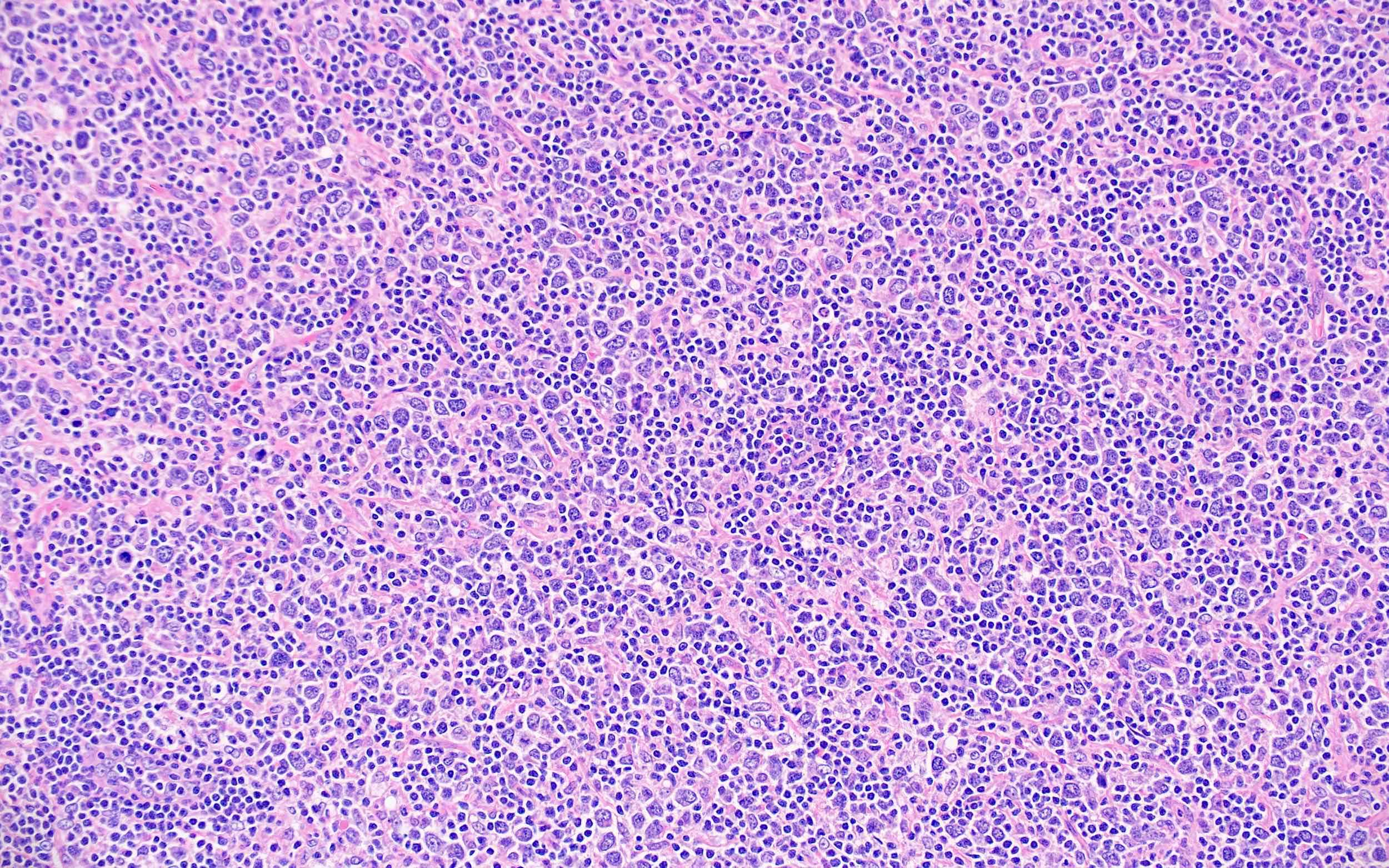 Large atypical cells of DLBCL